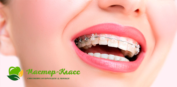 Установка имплантата Dentium под ключ + металлические или керамические брекеты на 1 или 2 челюсти в стоматологии «Мастер-класс». **Скидка до 79%**. Москва - kupikupon.ru Установка имплантата Dentium под ключ + металлические или керамические брекеты на 1 или 2 челюсти в стоматологии «Мастер-класс». **Скидка до 79%**