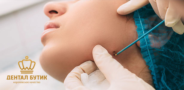 Удаление новообразований радиоволновым методом на аппарате Surgitron в многопрофильной клинике «Дентал бьюти бутик». **Скидка до 87%**